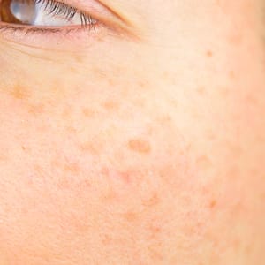 Age Spots