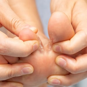 Athlete's Foot