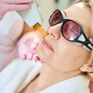 Candela CO2RE® Laser