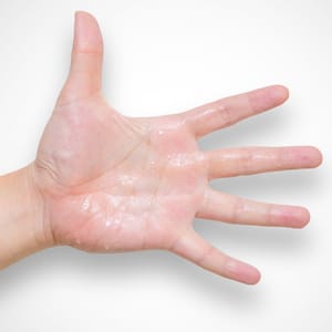 Hyperhidrosis