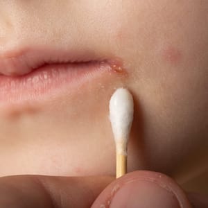 Impetigo