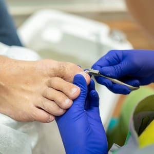Ingrown Nails
