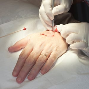 Mohs Surgery