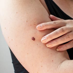 Moles