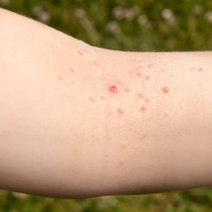Molluscum Contagiosum