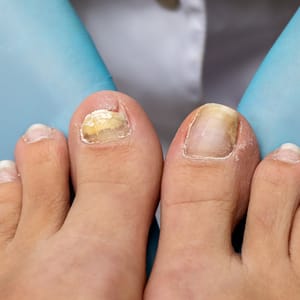 Nail Fungus
