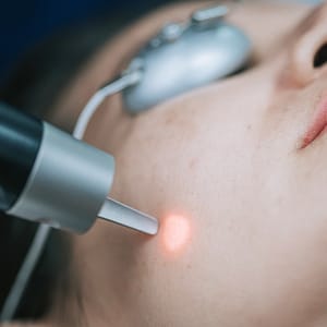 PicoToning Laser