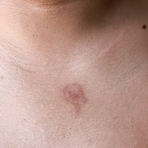 Pityriasis Rosea