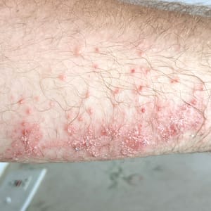 Poison Ivy Rash