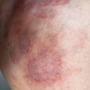 Ringworm