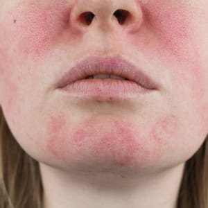 Rosacea