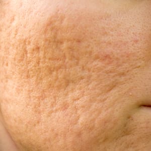 Scar Subcision and Punch Elevation