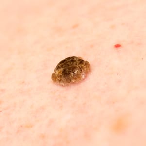 Seborrheic Keratosis