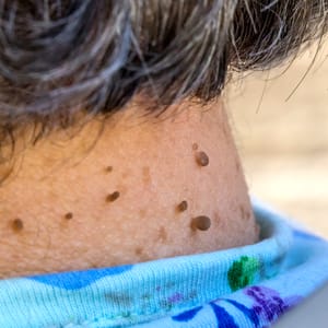 Skin Tags