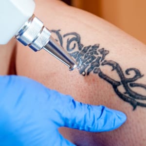Tattoo Removal