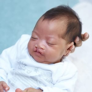 Cleft Lip and Palate Surgery