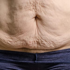 Post weight-loss surgery