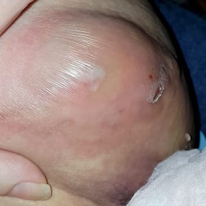 Hidradenitis Suppurativa