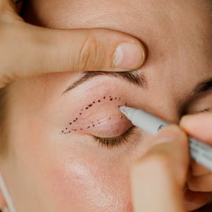 Blepharoplasty