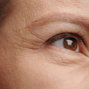 Xeomin® for Wrinkle Reduction