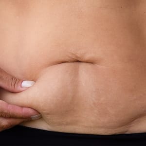 Thermi250® Skin Tightening