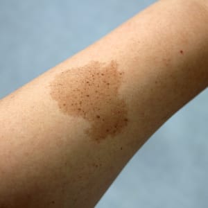 Birthmark