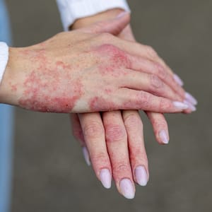 Eczema