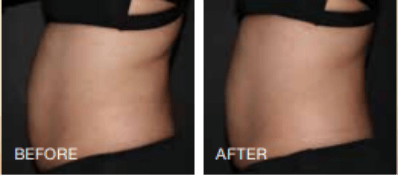 Before and After