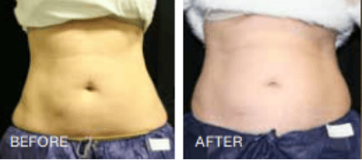 Before and After