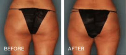 Before and After