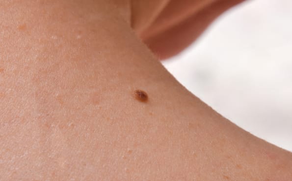 skin-cancer
