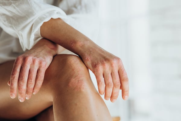 Exploring My Psoriasis Treatment Options