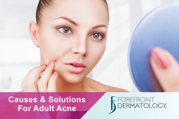 Causes and Solutions for Adult Acne