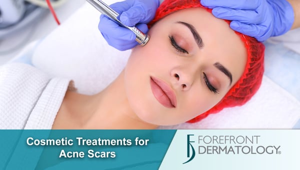 Cosmetic Treatments for Acne Scarring