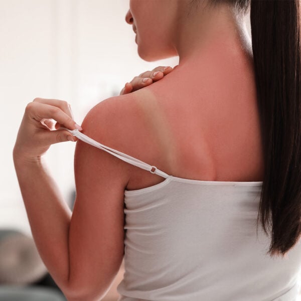 How to Treat Sunburn