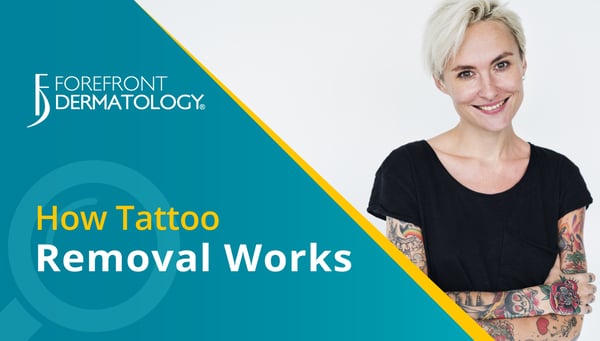 How Tattoo Removal Works