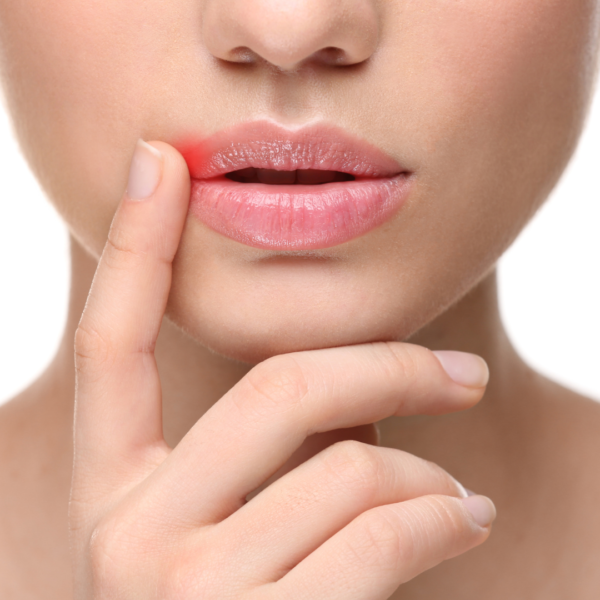 How to Treat a Cold Sore