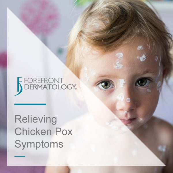 Relieving Chicken Pox Symptoms