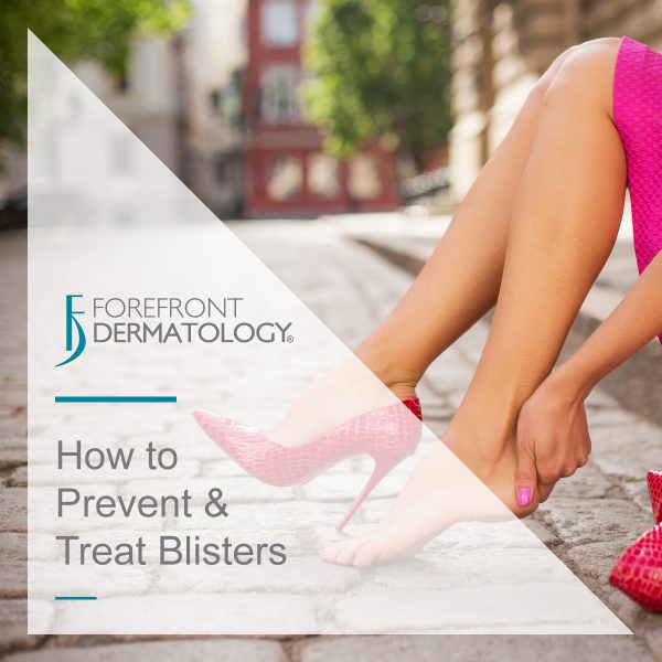 How to Prevent and Treat Blisters