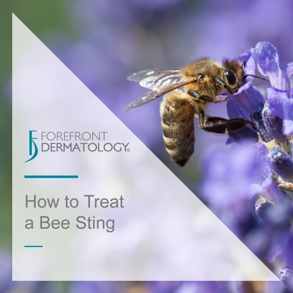 How to Treat a Bee Sting