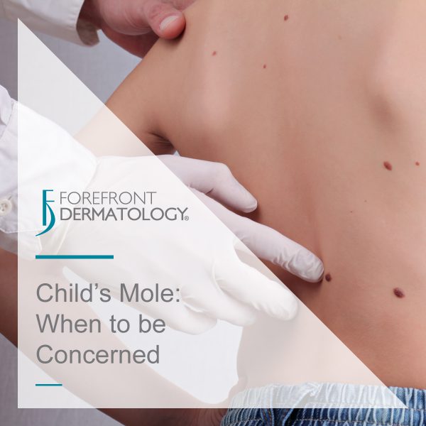 When to Be Concerned About a Child’s Mole