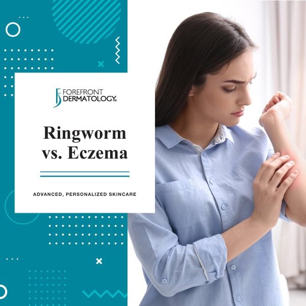 Ringworm Vs Eczema