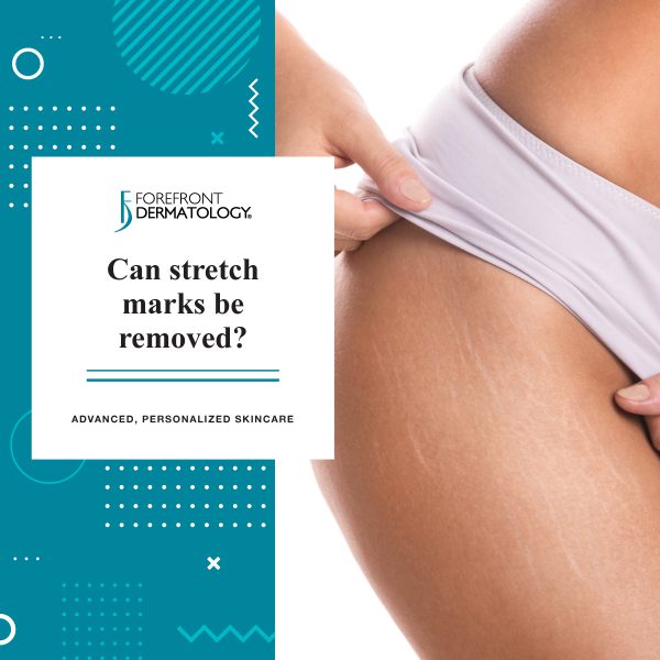 Can Stretch Marks Be Removed?  Forefront Dermatology - Forefront  Dermatology