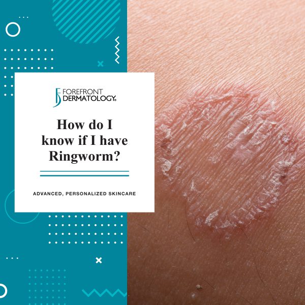 How Do I Know If I Have Ringworm?