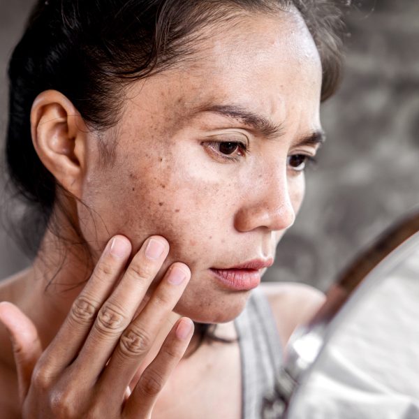 Acne Scar Removal - Forefront Dermatology
