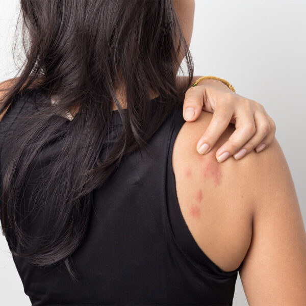 What Causes Hives Forefront Dermatology