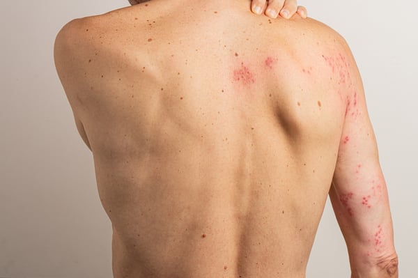 What’s the difference between shingles and chickenpox?