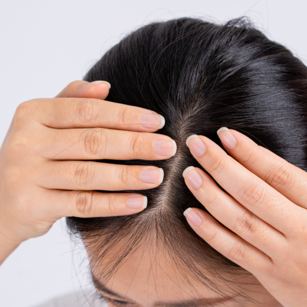At-Home Dry Scalp Treatment