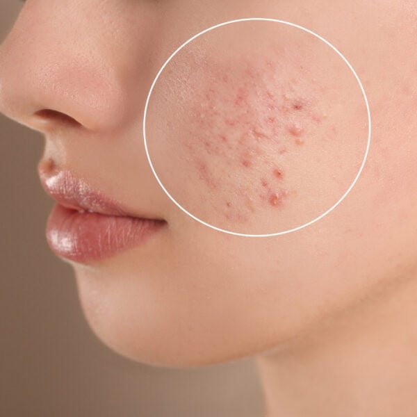 A Guide to Acne Scar Removal