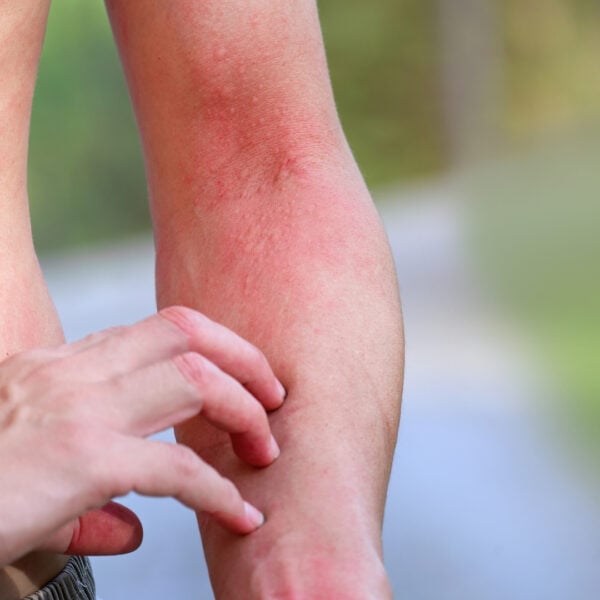 A Guide to Common Summer Rashes